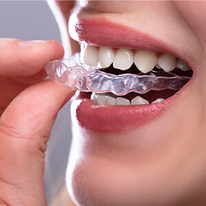 Braces / Clear Aligners