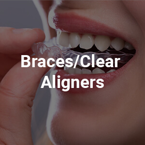 Bracers / Clean Aligners