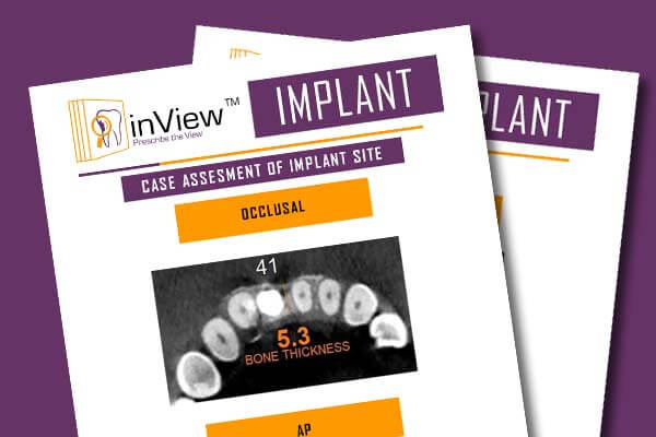 Inview Implant