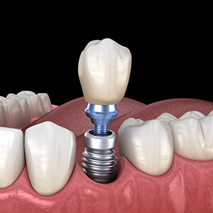 Dental Implant