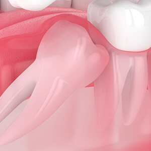 Impacted Tooth